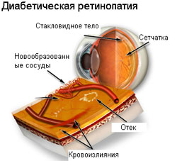 Диабетическая ретинопатия - причины, симптомы, лечение