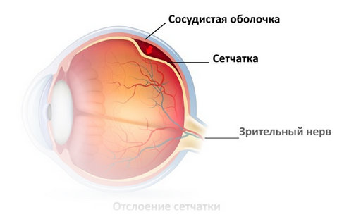 После операции сетчатки глаза ограничения