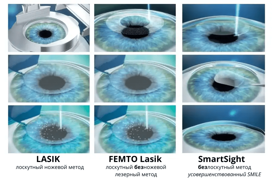 lasik