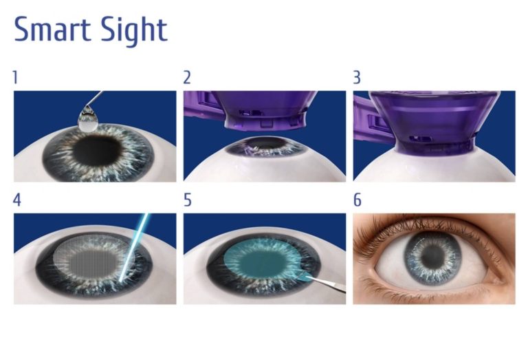 Smart Sight