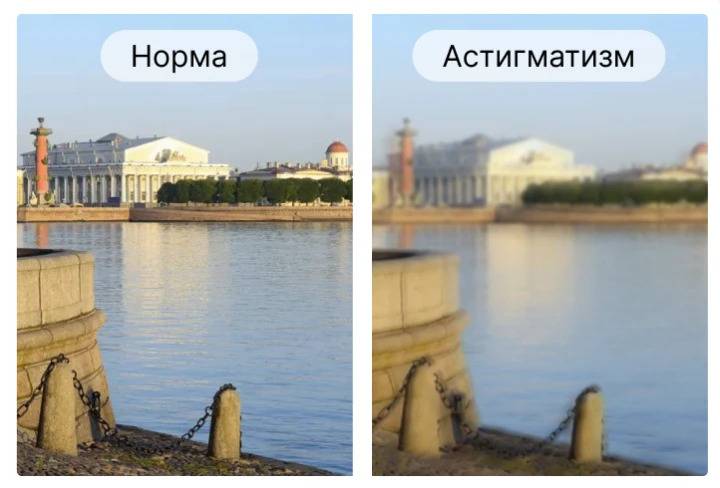 Что такое астигматизм