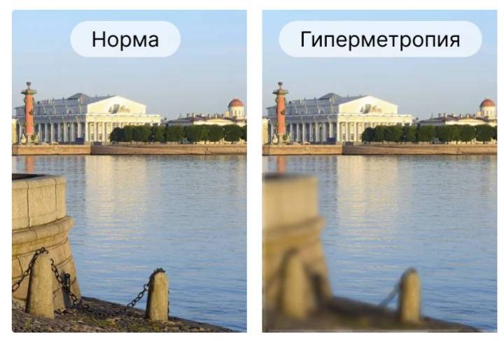 Что такое гиперметропия (дальнозоркость)
